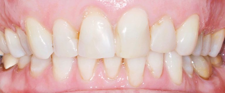 retracted-before - Dentalspa Geelong