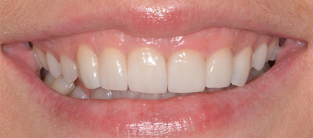 Veneers