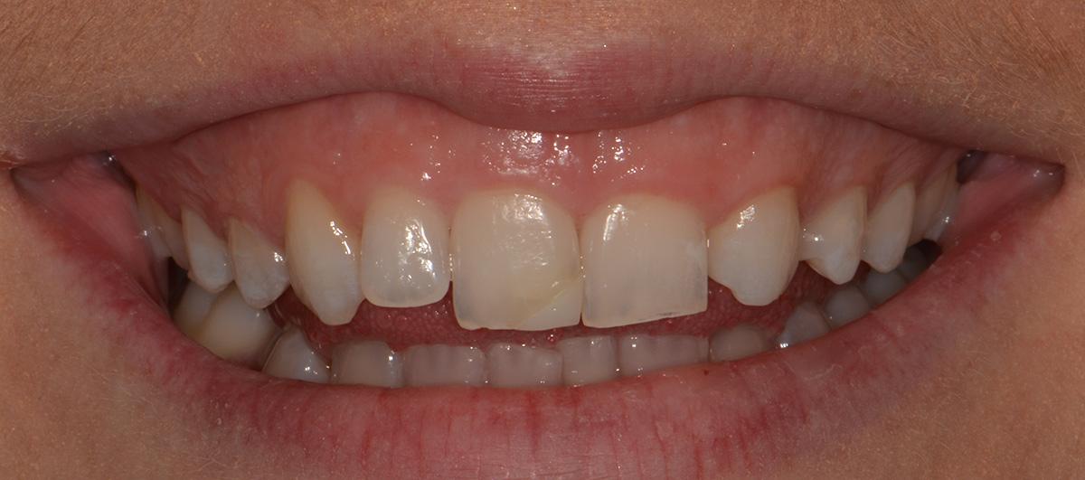 Veneers