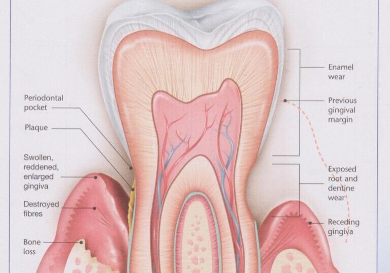 Sensitive Teeth