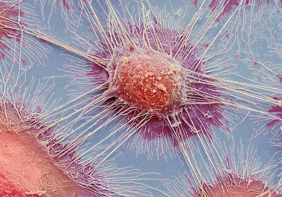 Carcinoma