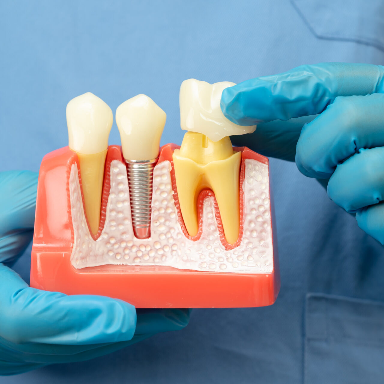 Dental crown in Geelong at Dental Spa Geelong