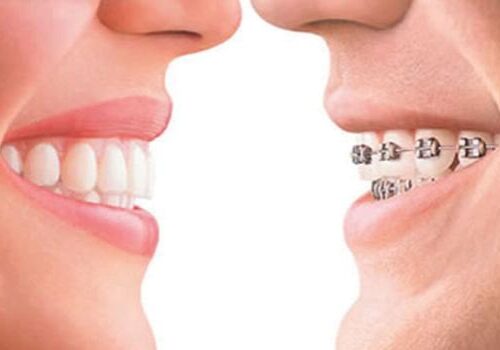 Invisalign Vs Braces1