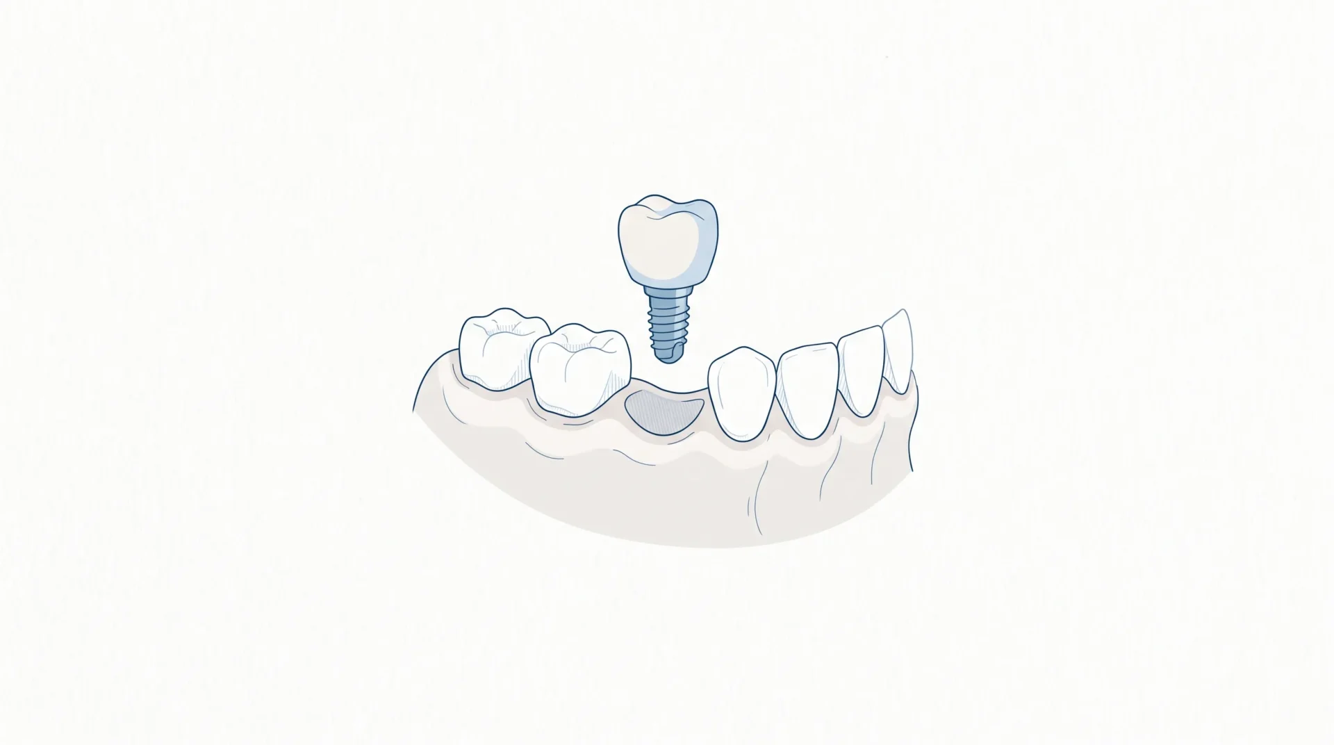 Close-up of a missing tooth site prepared for a dental implant crown in the lower jaw.