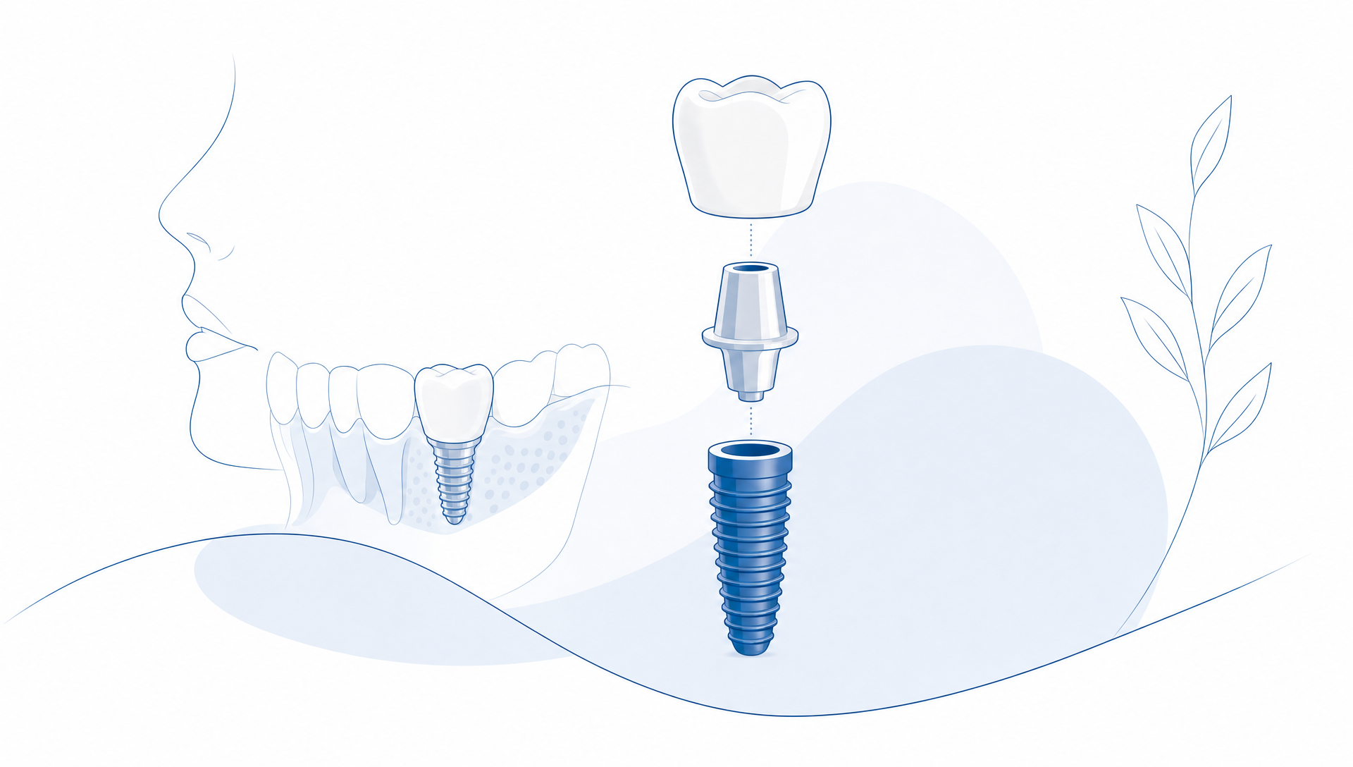 Dental Implants Explained From Consultation to Care - Main Image