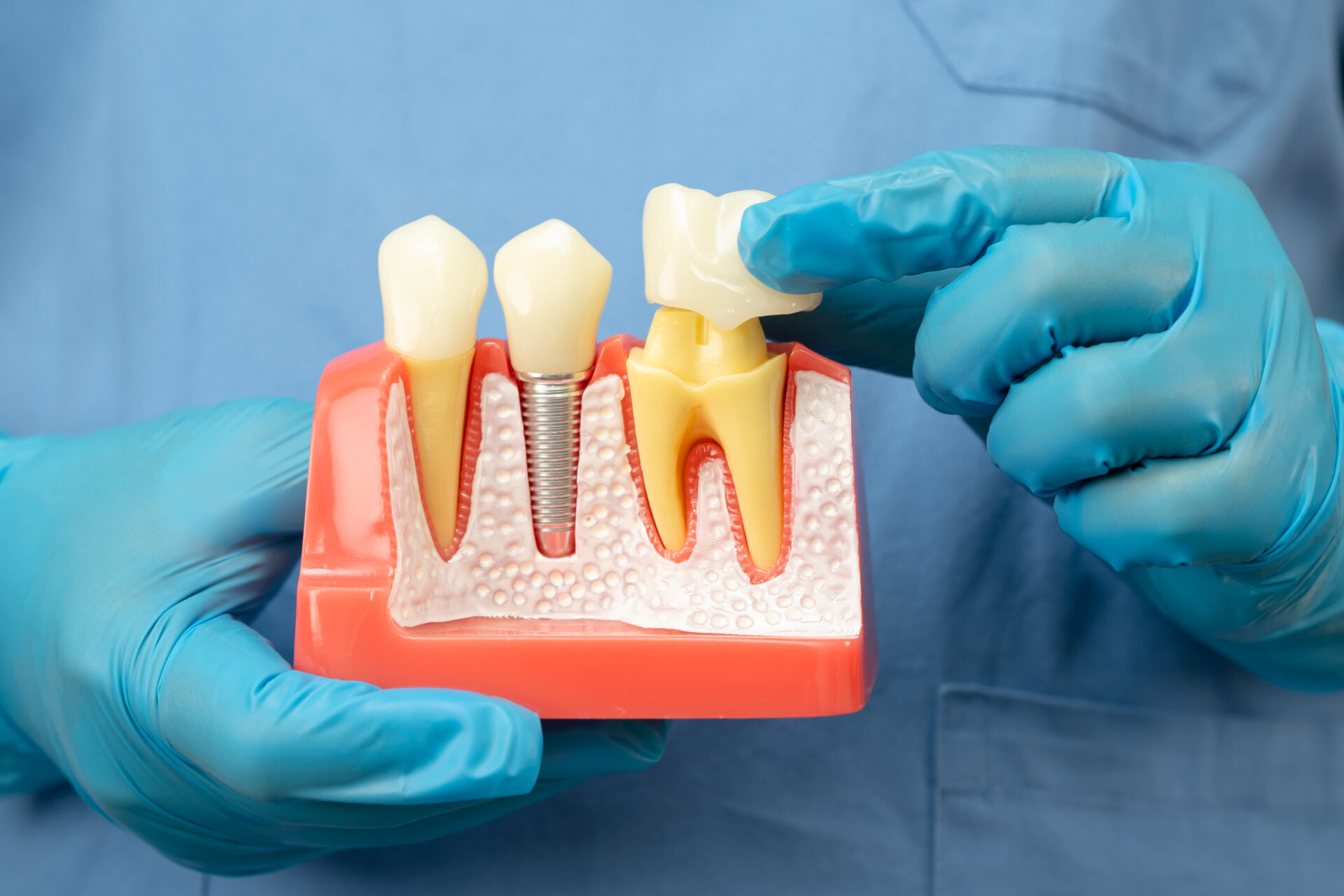 Dental crown in Geelong at Dental Spa Geelong