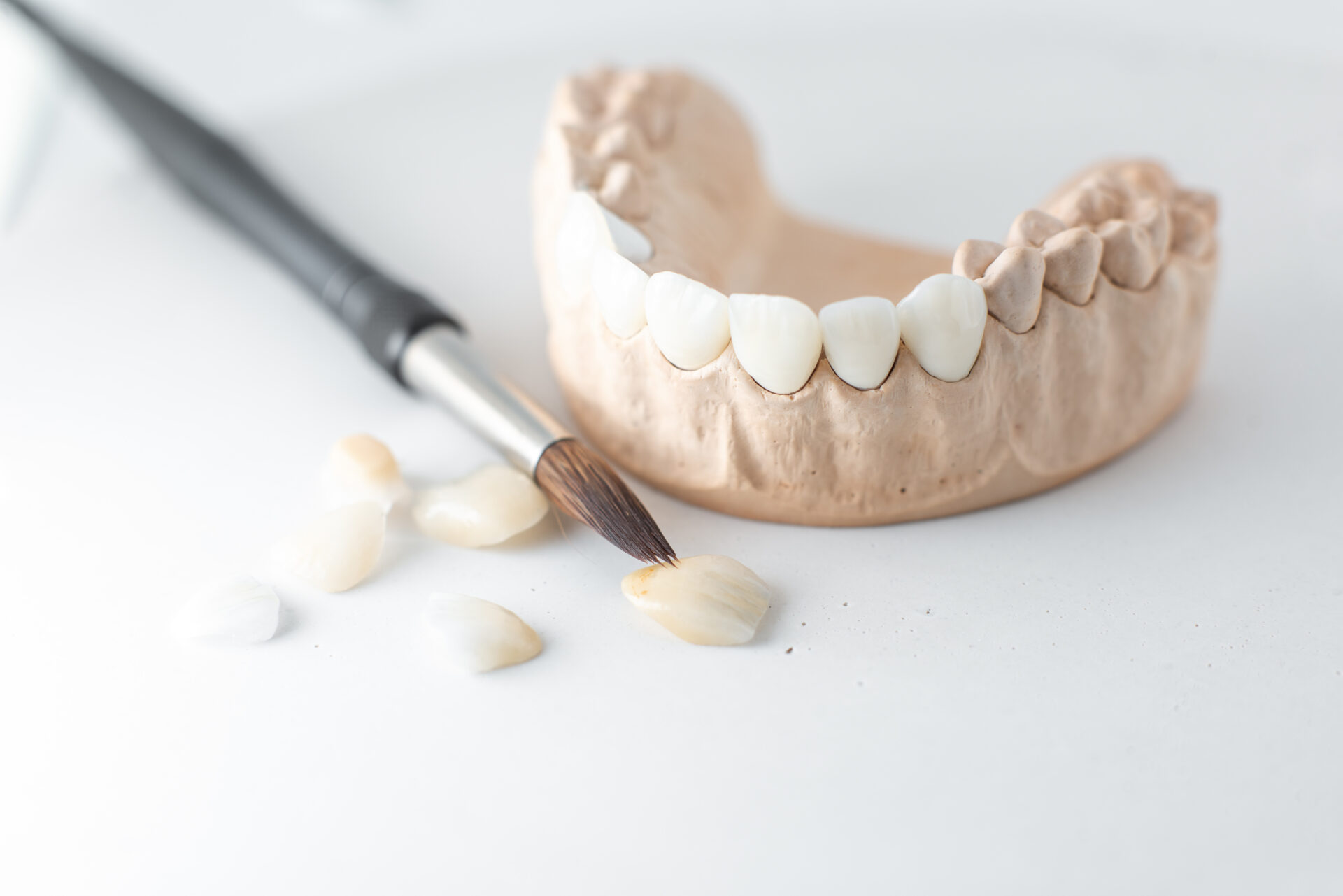 Custom-made porcelain veneer shells crafted at Dentalspa Geelong to match the natural colour and shape of surrounding teeth
