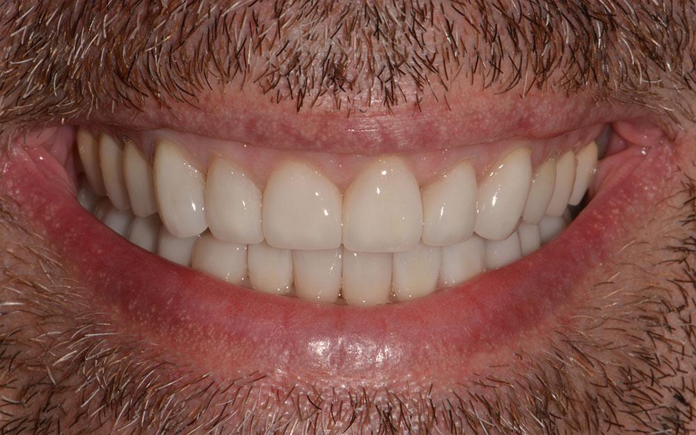 A combination of Invisalign and porcelain crowns