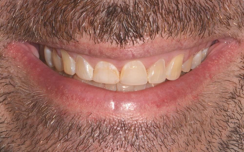 A combination of Invisalign and porcelain crowns