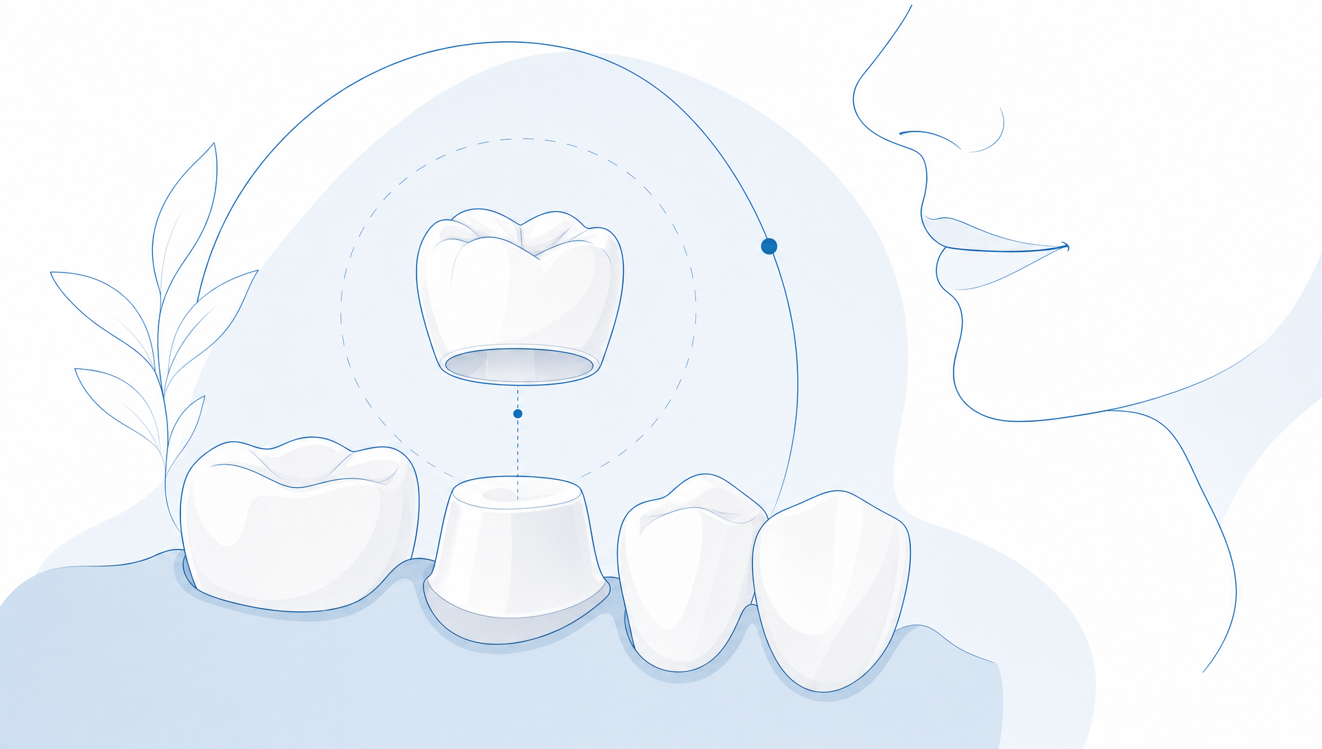 When Do Teeth Crowns Need Replacement? - Main Image